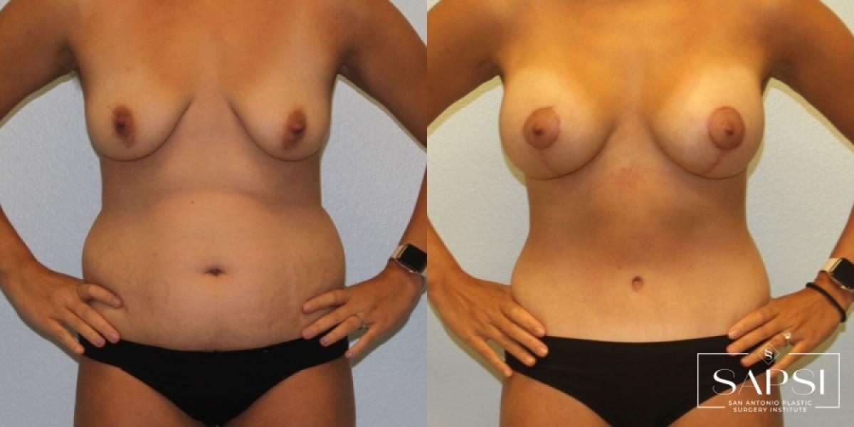 Breast Augmentation: Patient 56 - Before and After 1