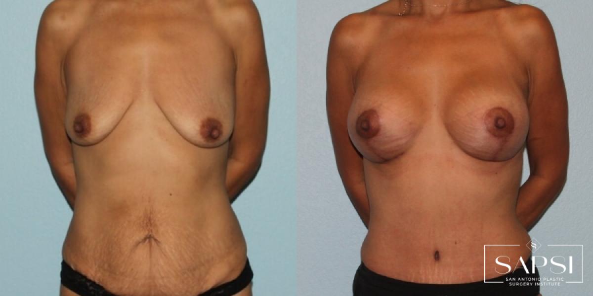 Breast Augmentation With Lift: Patient 5 - Before and After  