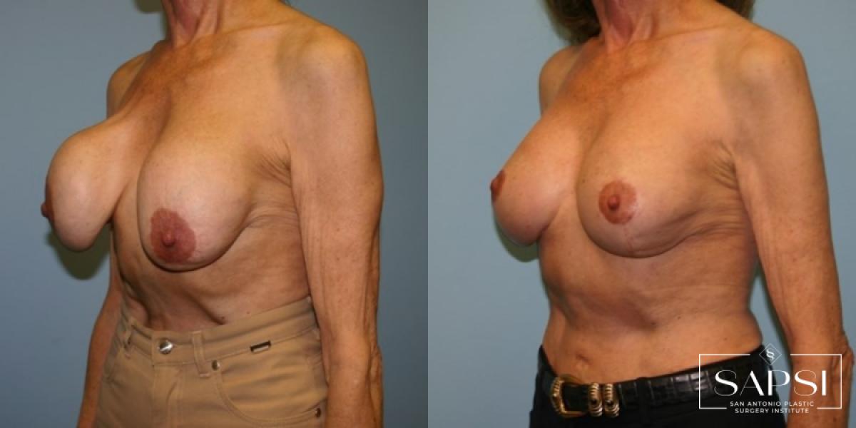 Breast Revision: Patient 9 - Before and After 2