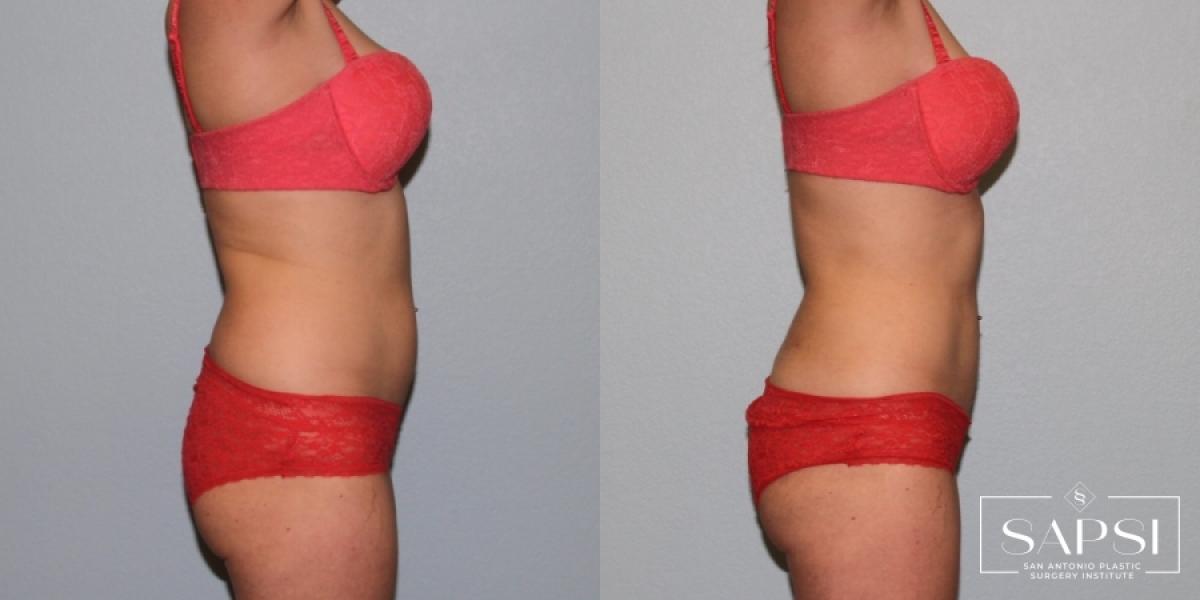 Body Contouring: Patient 1 - Before and After 2