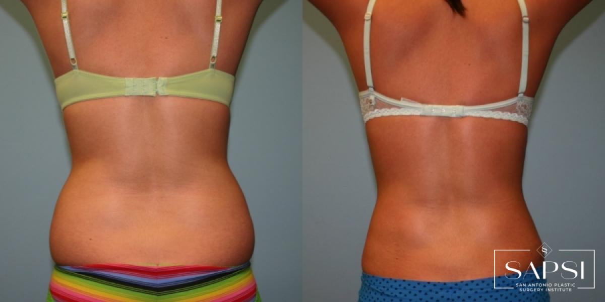 Body Contouring: Patient 2 - Before and After 3