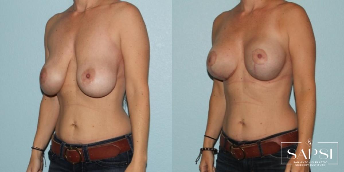 Breast Augmentation With Lift: Patient 19 - Before and After 2