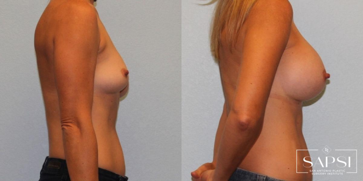 Breast Augmentation: Patient 19 - Before and After 3