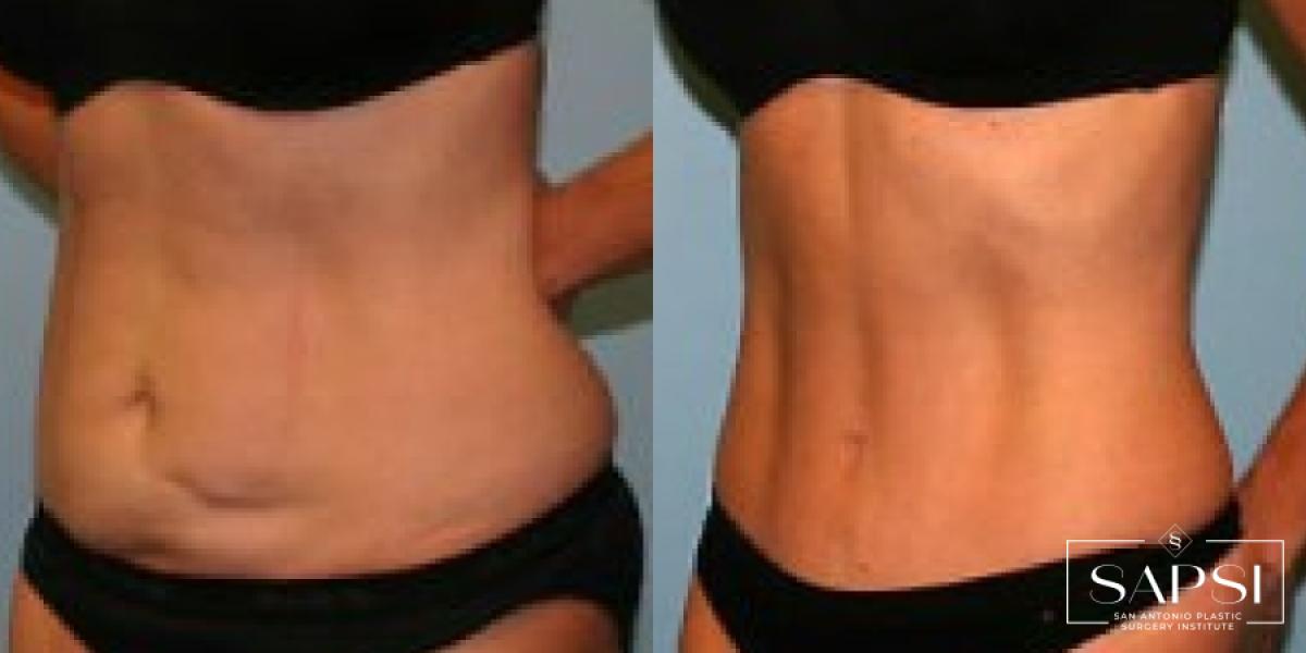 Tummy Tuck: Patient 31 - Before and After 2