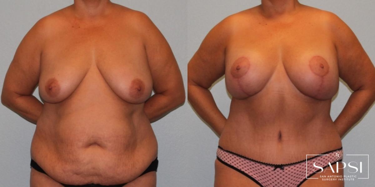 Breast Augmentation With Lift: Patient 14 - Before and After 1