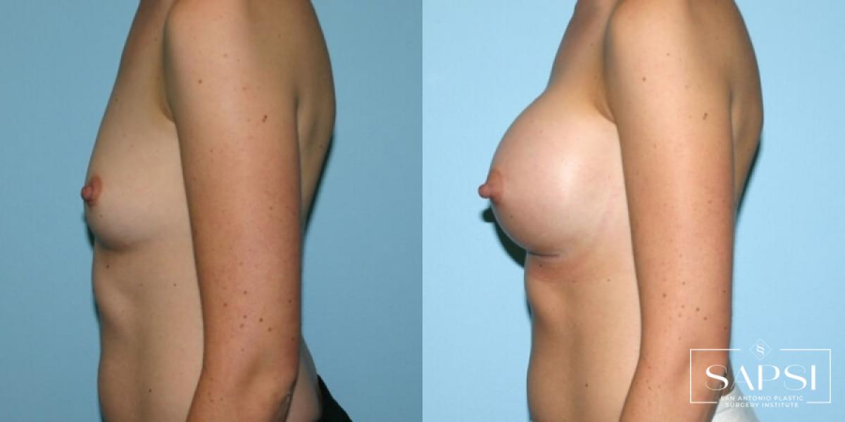 Breast Augmentation: Patient 6 - Before and After 3