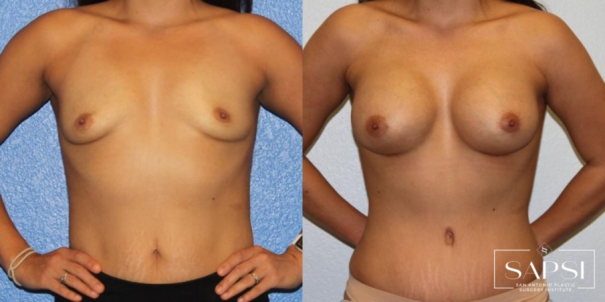 Tummy Tuck: Patient 33 - Before and After 1