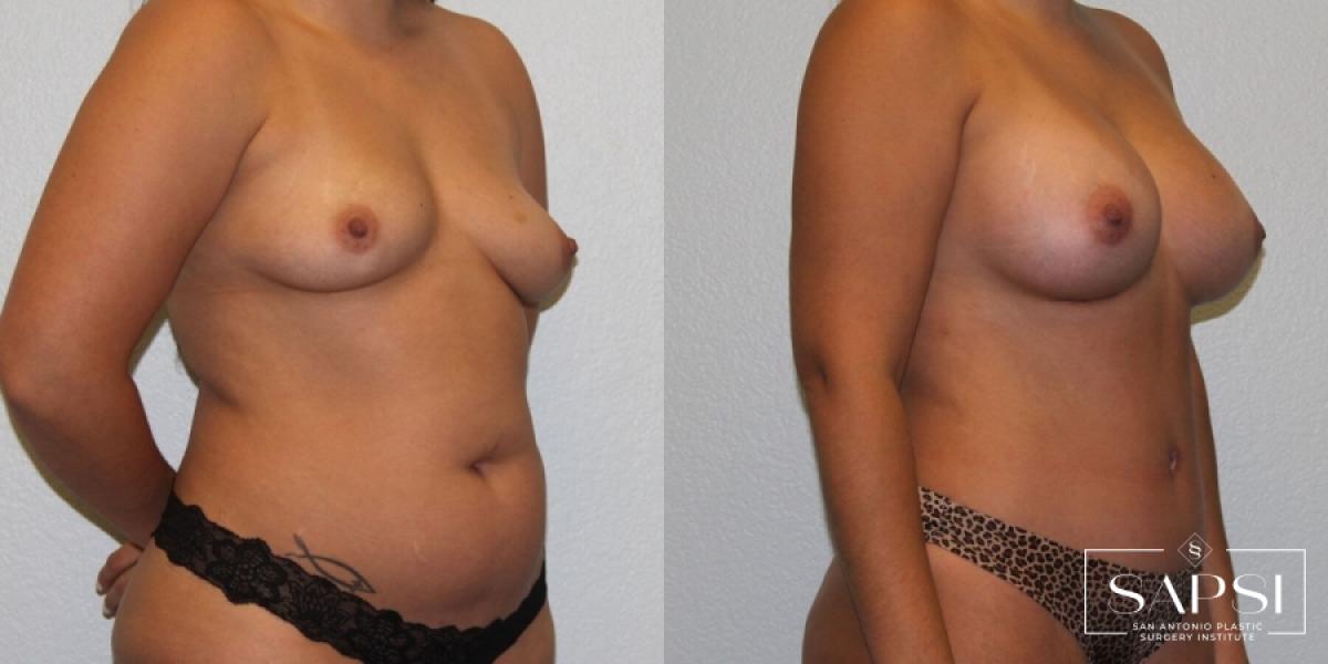 Breast Augmentation: Patient 75 - Before and After 2