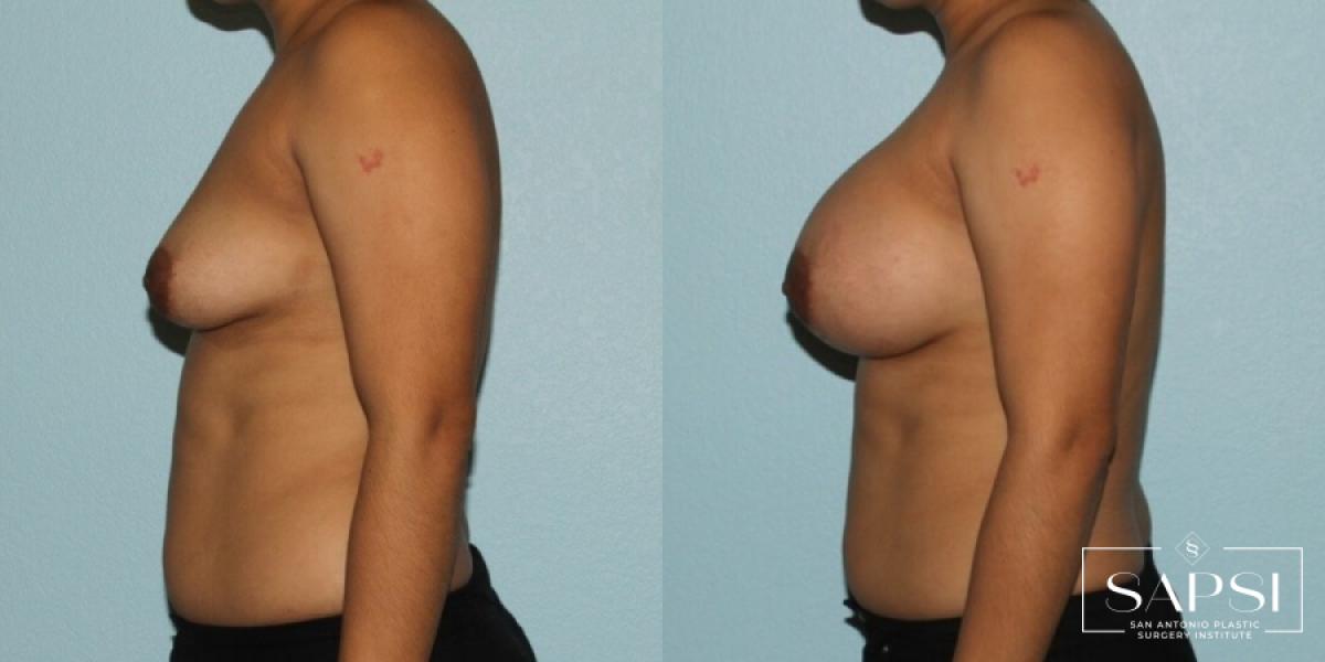 Breast Augmentation: Patient 33 - Before and After 3