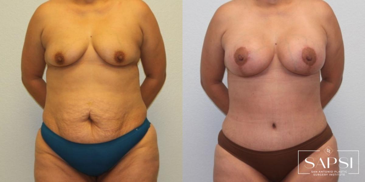 Breast Lift: Patient 12 - Before and After 1