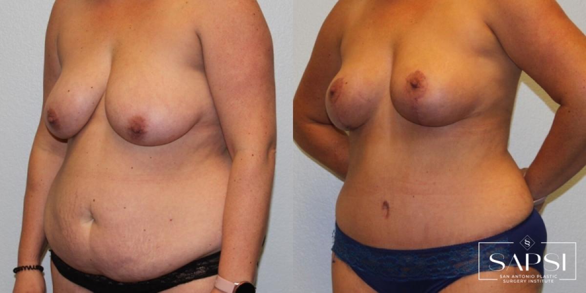 Body Lift: Patient 1 - Before and After 2