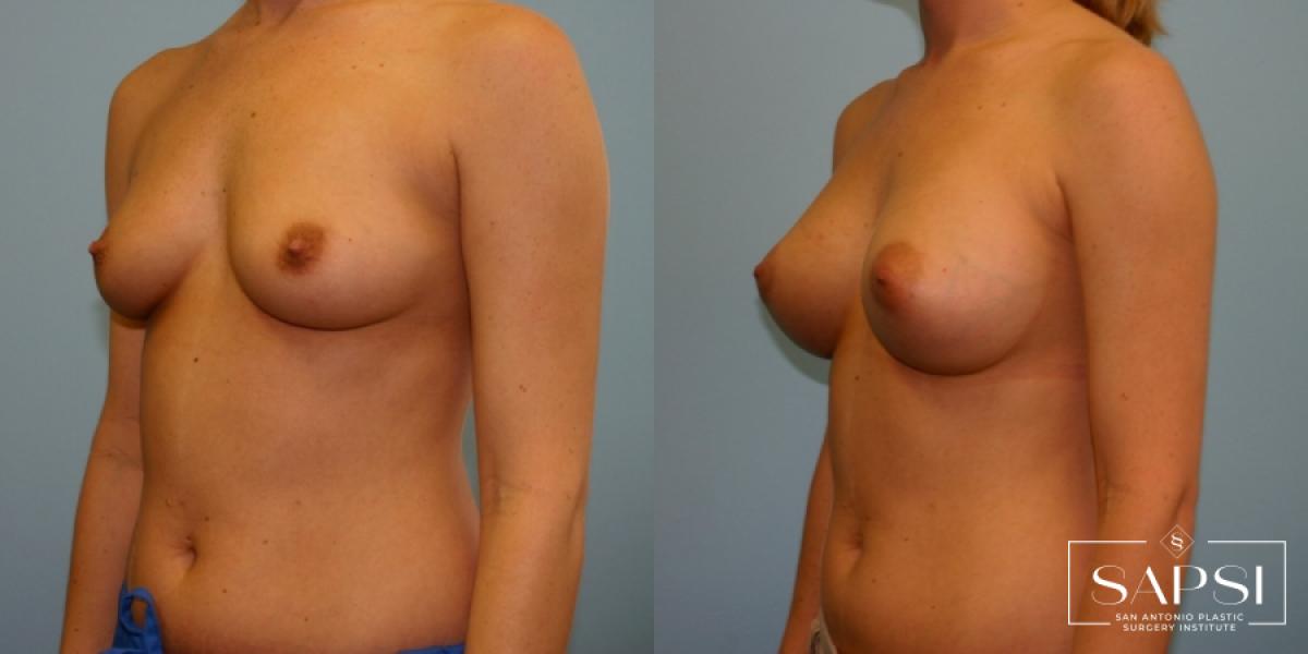 Breast Augmentation: Patient 12 - Before and After 2