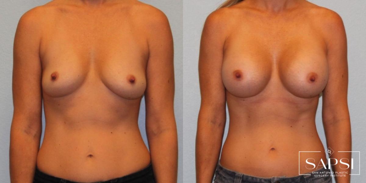 Breast Augmentation: Patient 20 - Before and After 