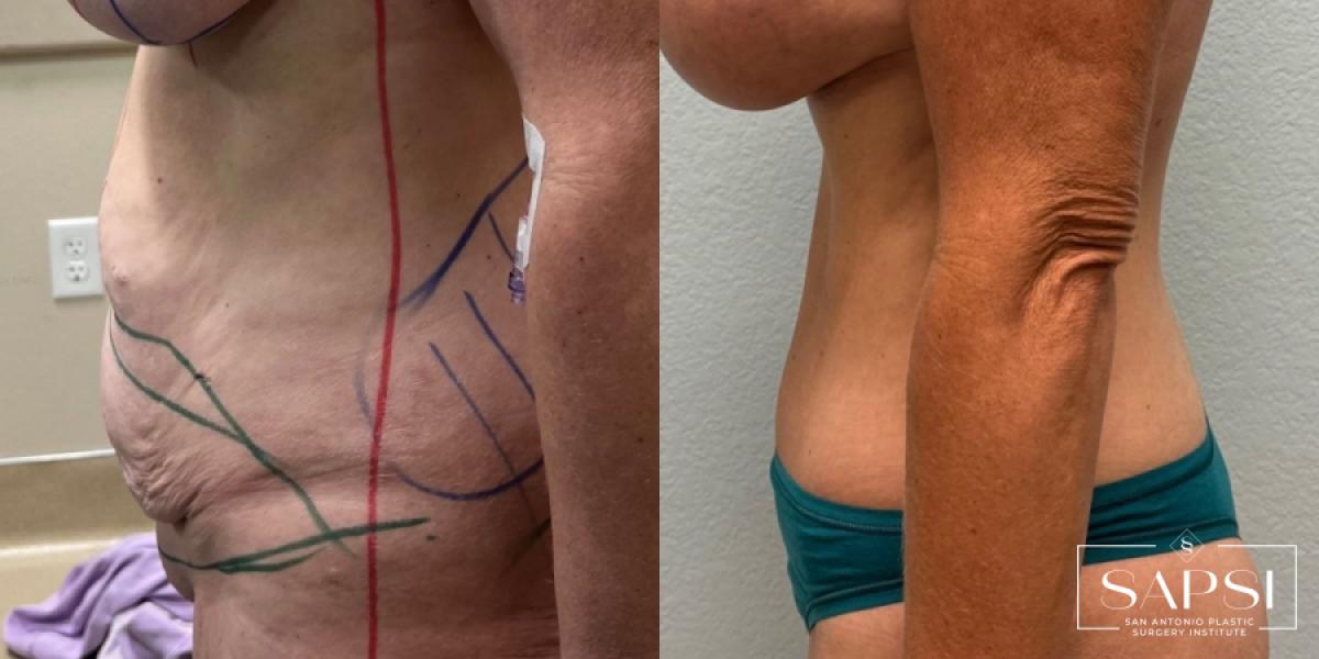 Tummy Tuck: Patient 1 - Before and After 3