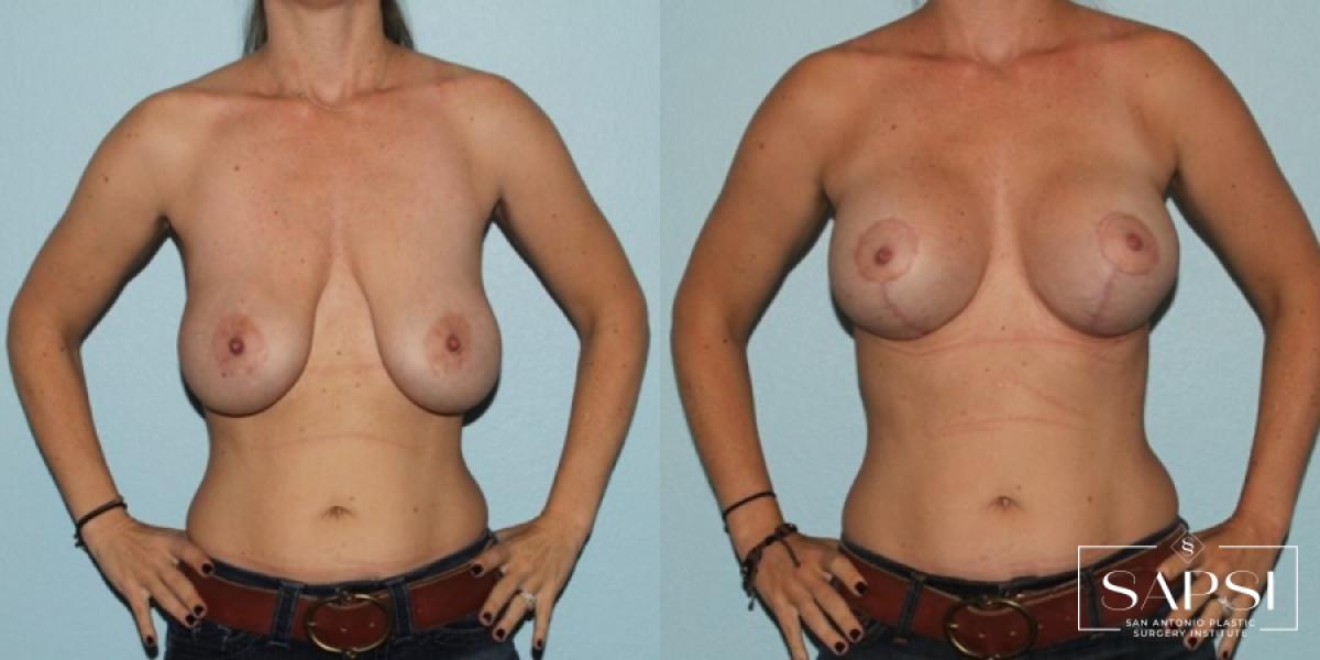 Breast Revision: Patient 12 - Before and After 