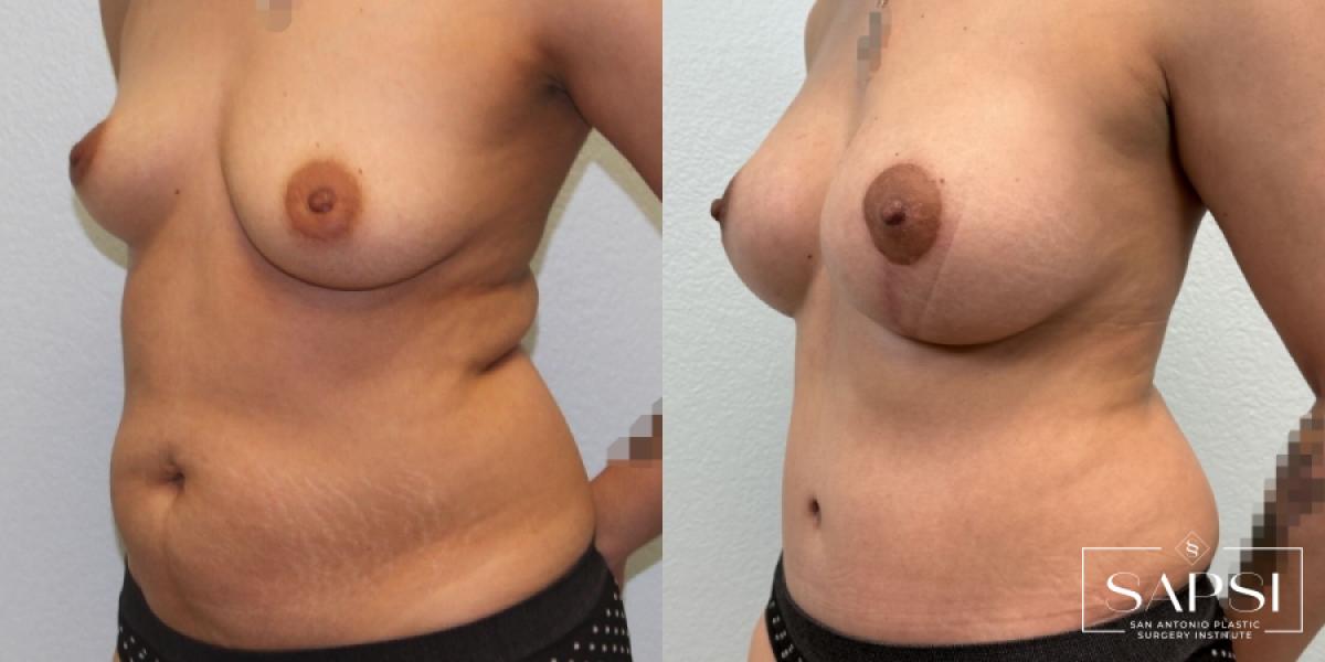 Tummy Tuck: Patient 6 - Before and After 2