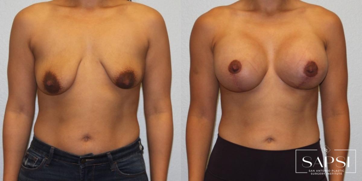 Breast Augmentation With Lift: Patient 1 - Before and After  