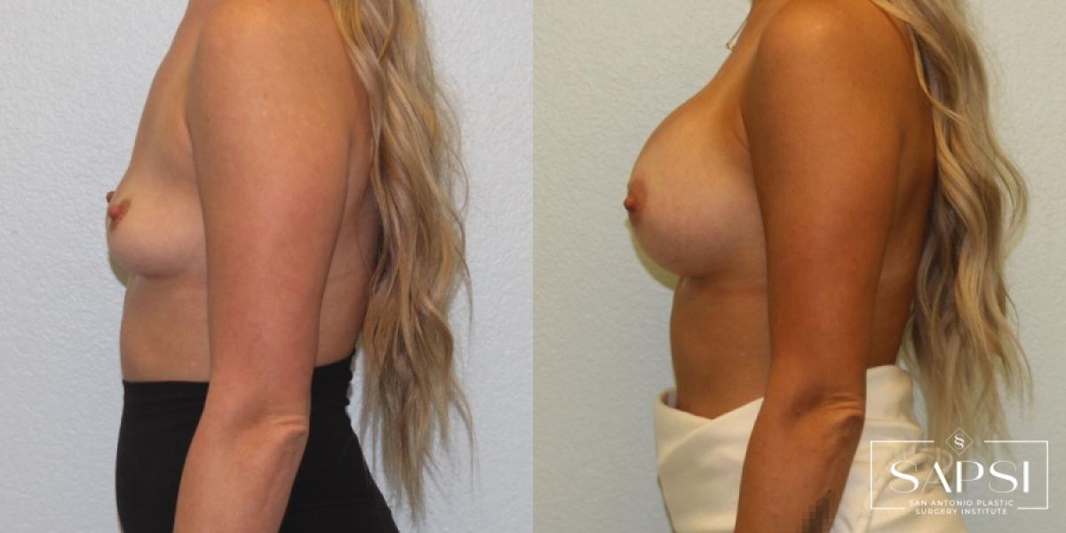 Breast Augmentation: Patient 59 - Before and After 3