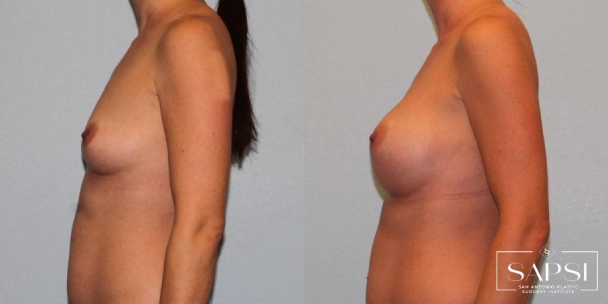 Breast Augmentation: Patient 18 - Before and After 3