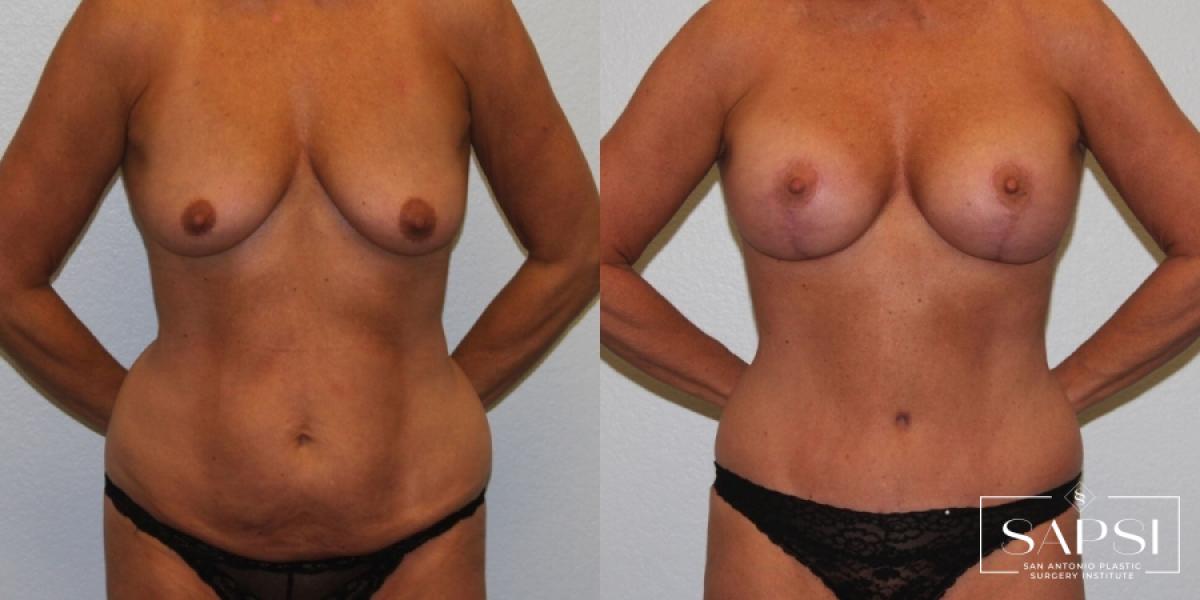 Breast Augmentation: Patient 62 - Before and After 1