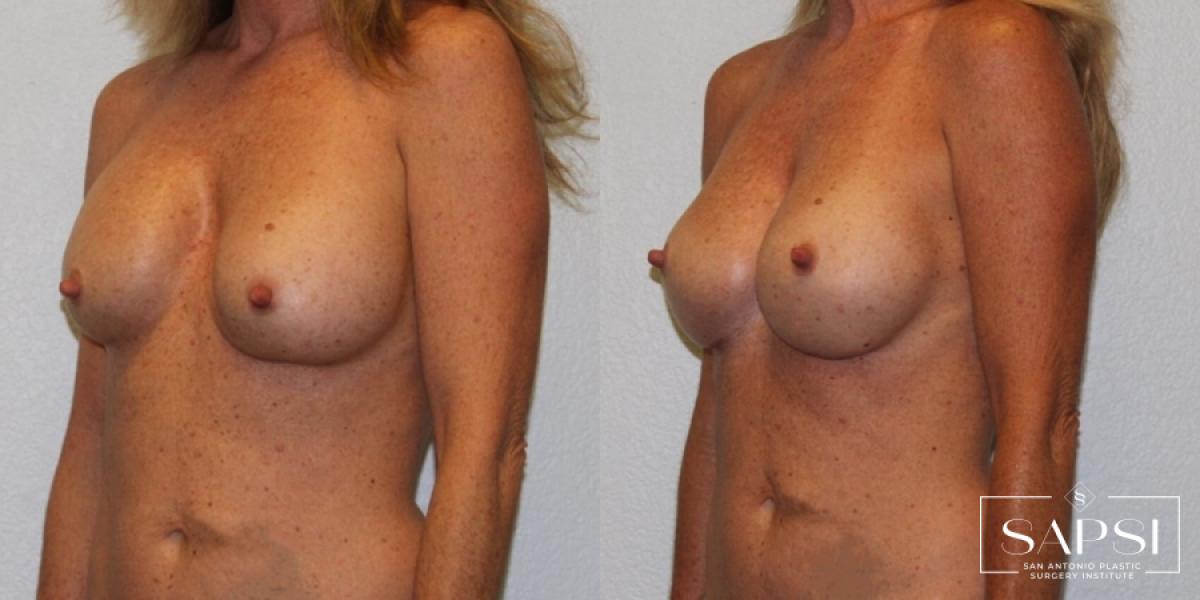 Breast Revision: Patient 7 - Before and After 2