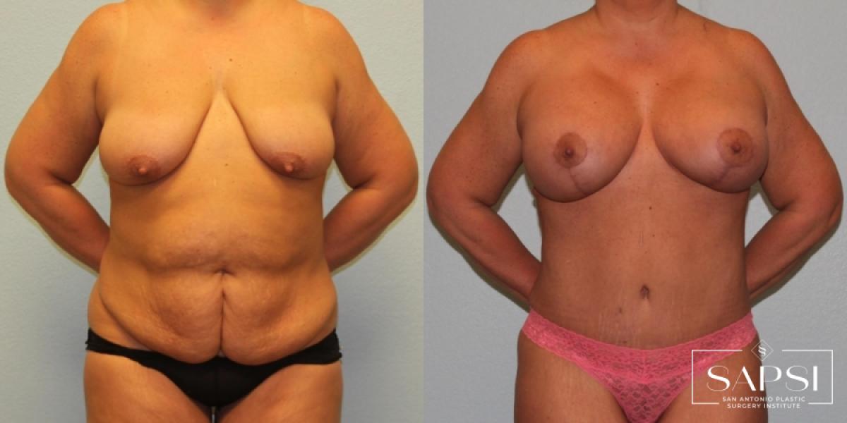 Breast Augmentation With Lift: Patient 12 - Before and After 1