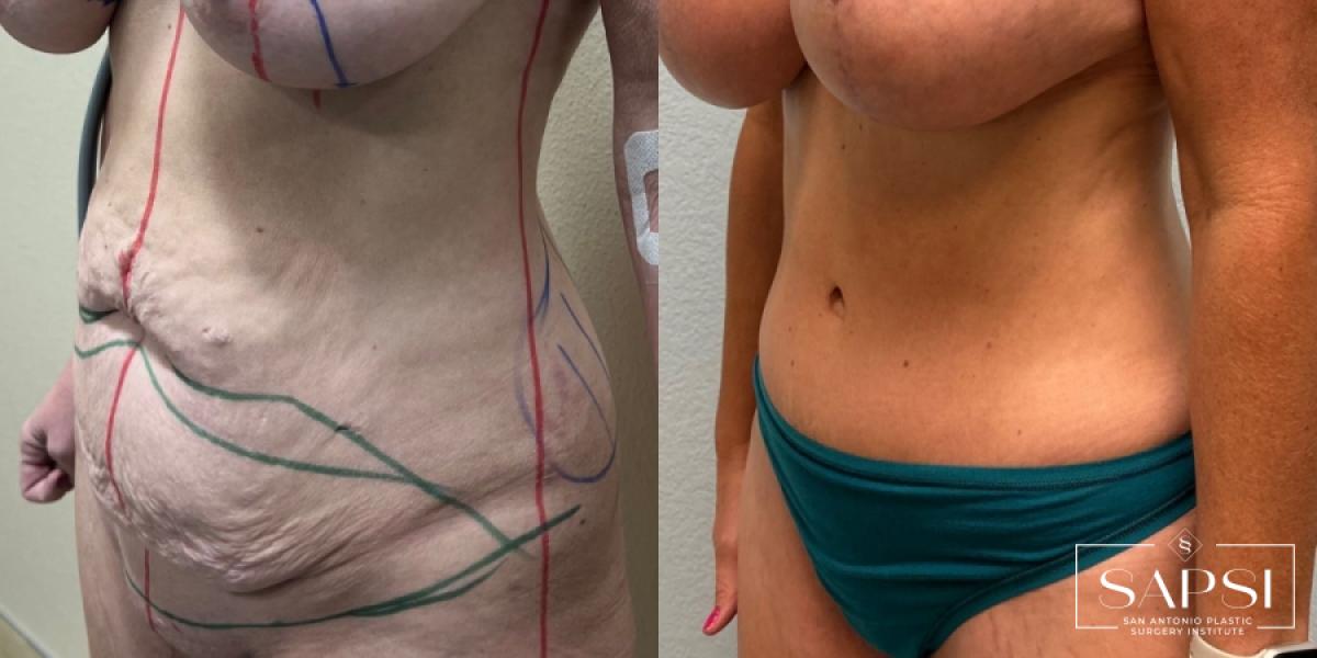 Tummy Tuck: Patient 1 - Before and After 2