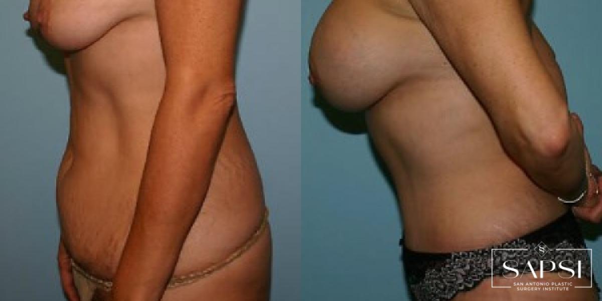 Tummy Tuck: Patient 43 - Before and After 3