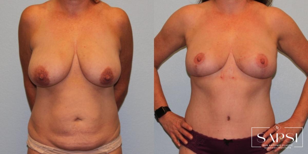 Breast Reduction: Patient 5 - Before and After  