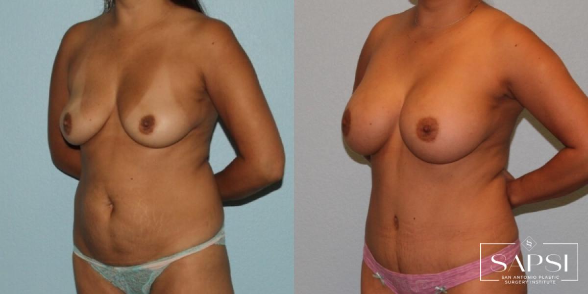 Breast Augmentation: Patient 70 - Before and After 2