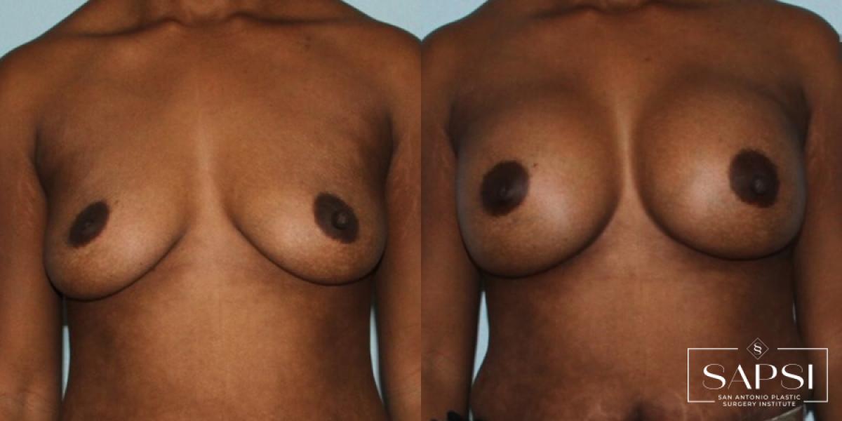 Breast Augmentation: Patient 45 - Before and After 1