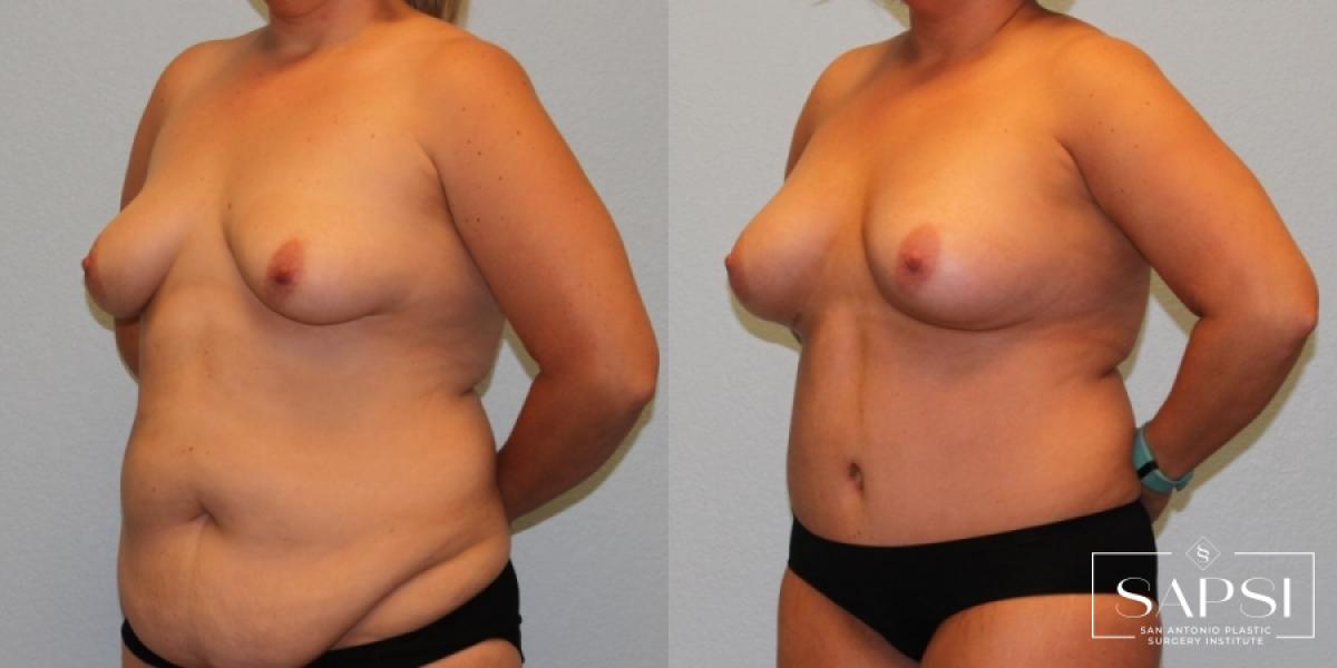 Tummy Tuck: Patient 34 - Before and After 2