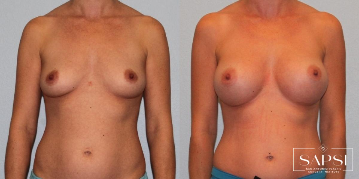 Breast Augmentation: Patient 19 - Before and After 