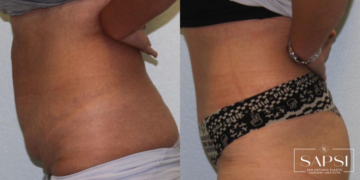 Tummy Tuck: Patient 23 - Before and After 3