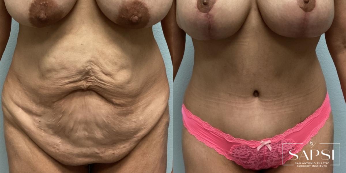 Tummy Tuck: Patient 7 - Before and After  