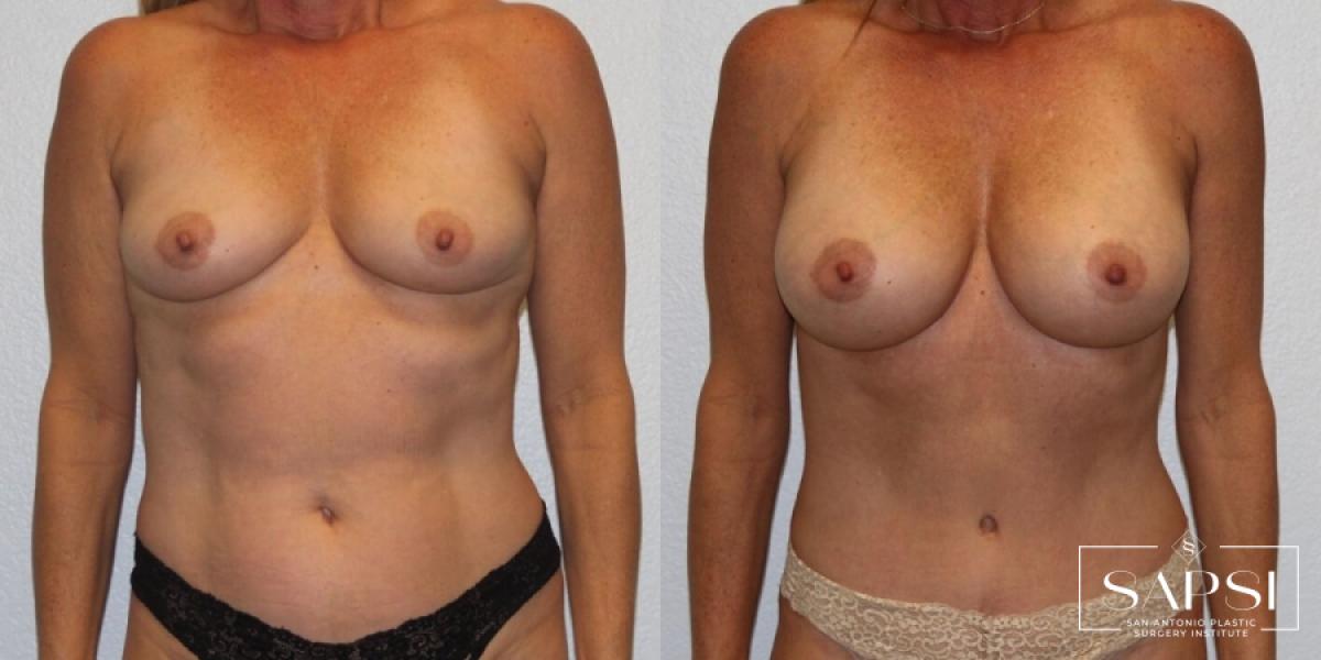 Breast Augmentation: Patient 56 - Before and After 