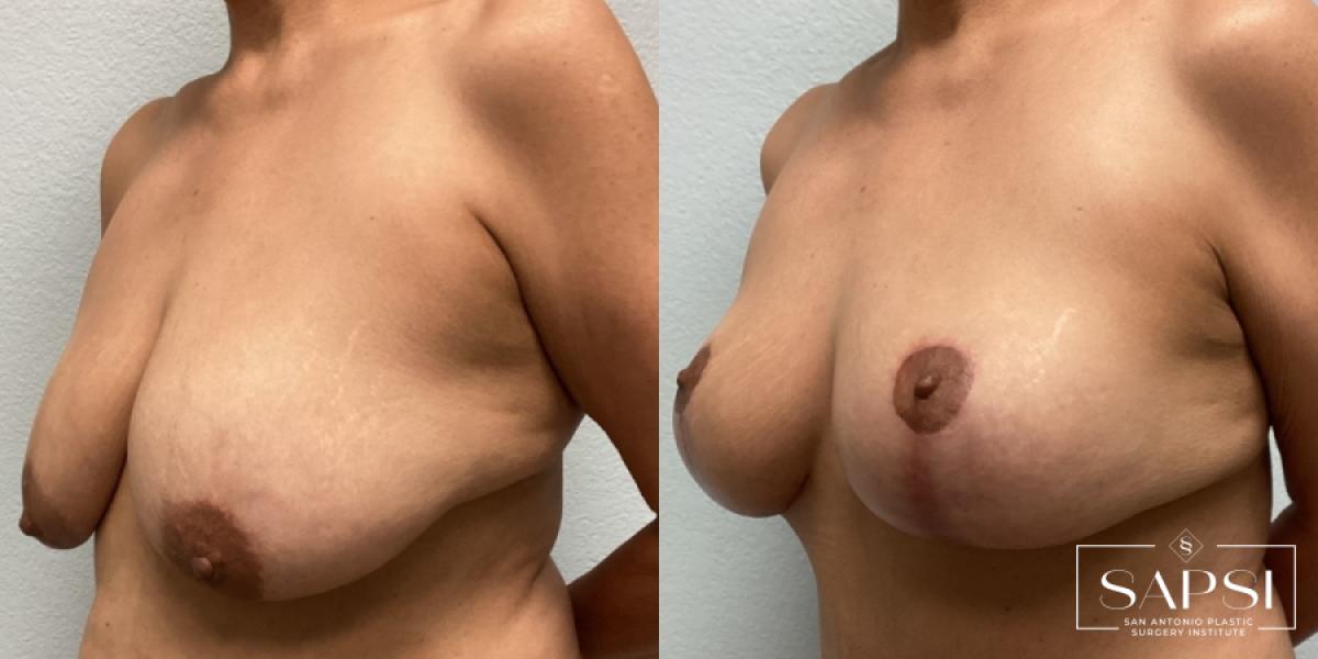 Breast Lift: Patient 19 - Before and After 2