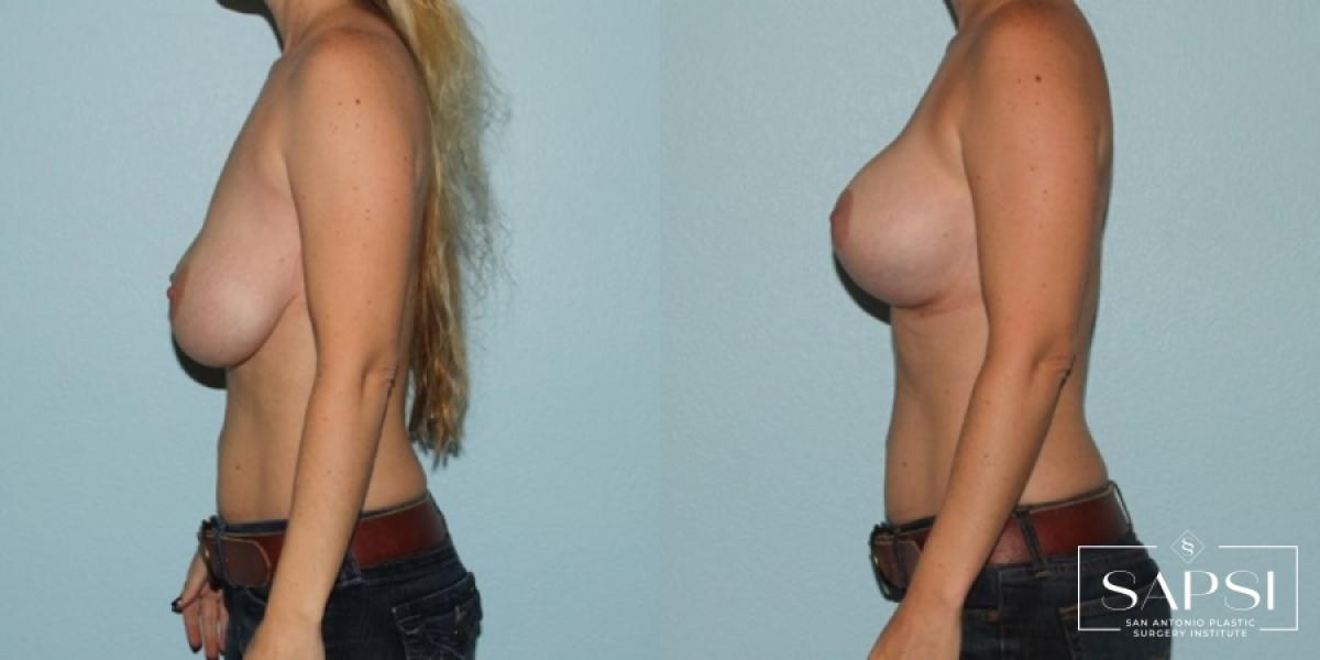 Breast Augmentation With Lift: Patient 19 - Before and After 3