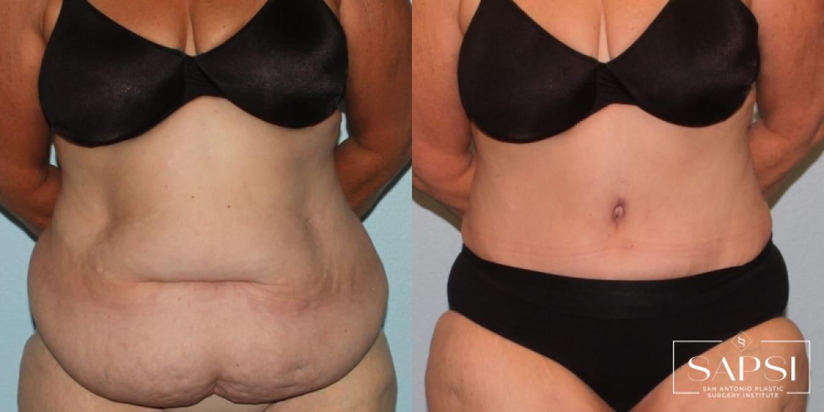 Liposuction: Patient 15 - Before and After 1