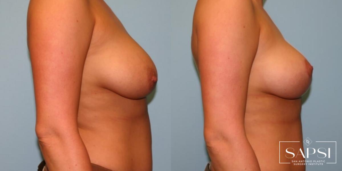 Breast Lift: Patient 13 - Before and After 2