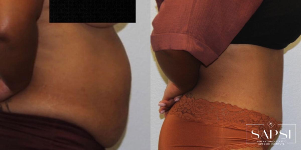 Body Contouring: Patient 3 - Before and After 3