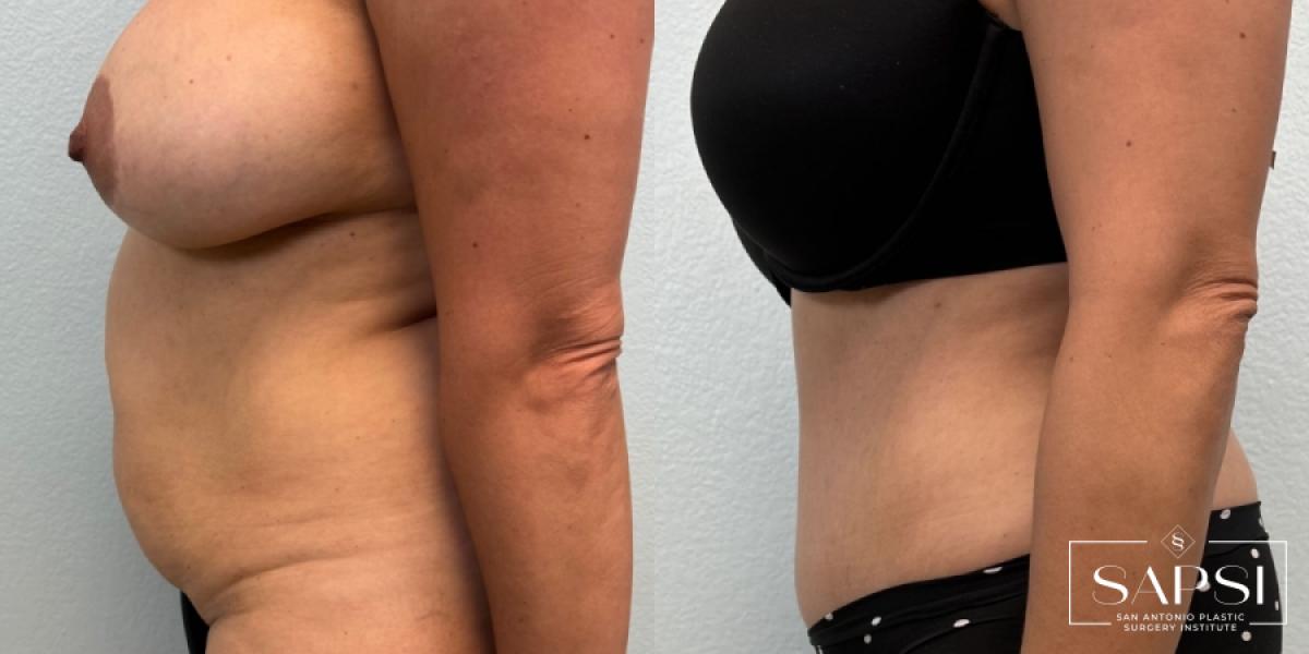 Tummy Tuck: Patient 2 - Before and After 3