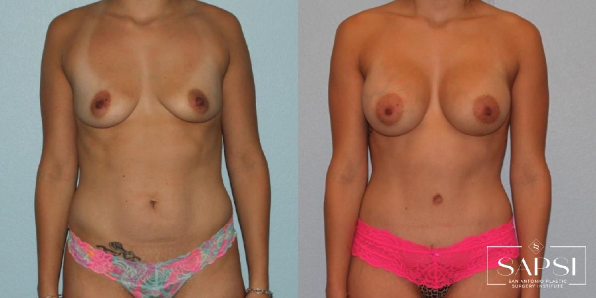 Tummy Tuck: Patient 32 - Before and After 1