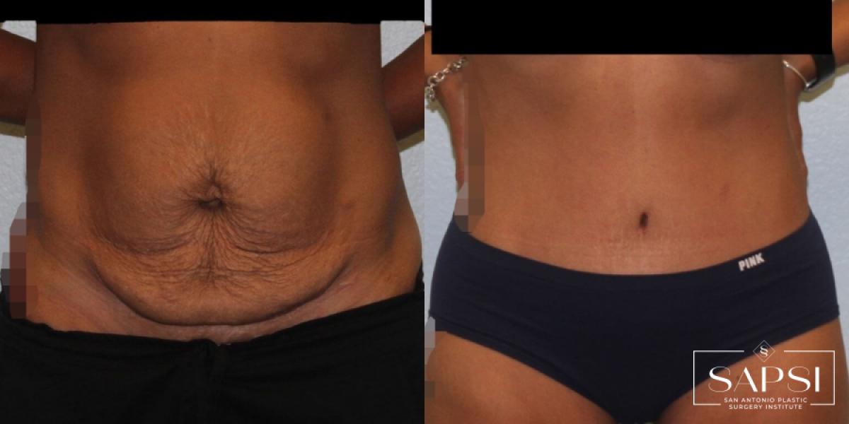 Tummy Tuck: Patient 20 - Before and After 1