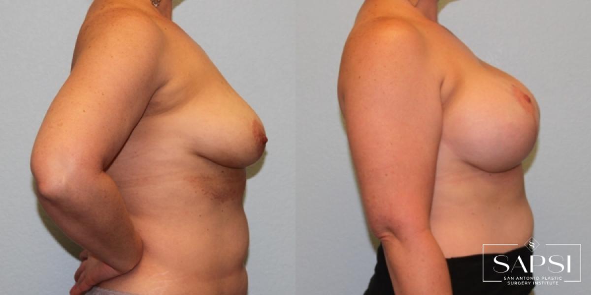 Breast Augmentation With Lift: Patient 3 - Before and After 3