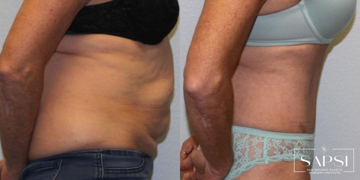 Tummy Tuck: Patient 16 - Before and After 3