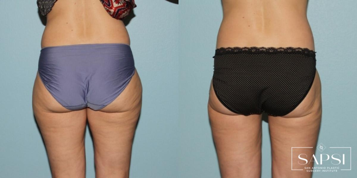 Liposuction: Patient 8 - Before and After 2