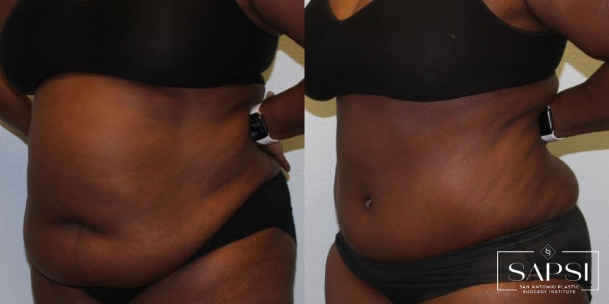 Tummy Tuck: Patient 22 - Before and After 2