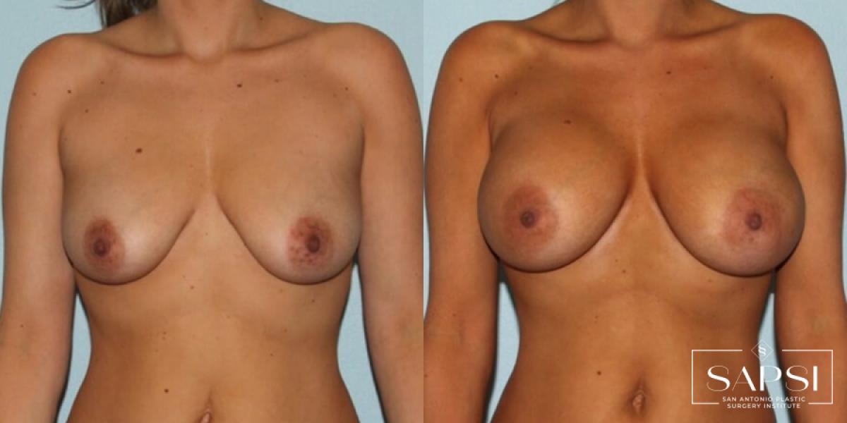 Breast Augmentation: Patient 2 - Before and After  