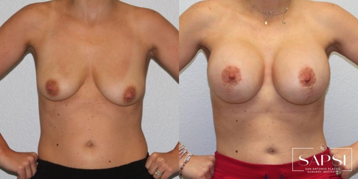 Breast Augmentation: Patient 55 - Before and After 